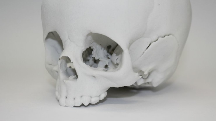 3d printing pediatric skull surgery simulation